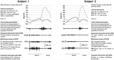 Added Value of Dynamic EMG in the Assessment of the Equinus and the Equinovarus Foot Deviation in Stroke Patients and Barriers Limiting Its Usage